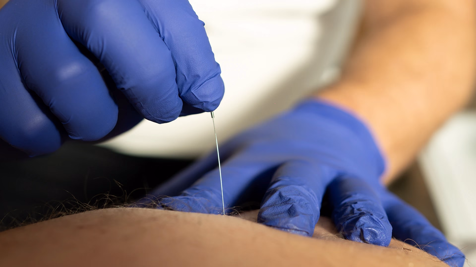 Tratamiento de punción seca en Rubén Roda Fisioterapia Vinaròs